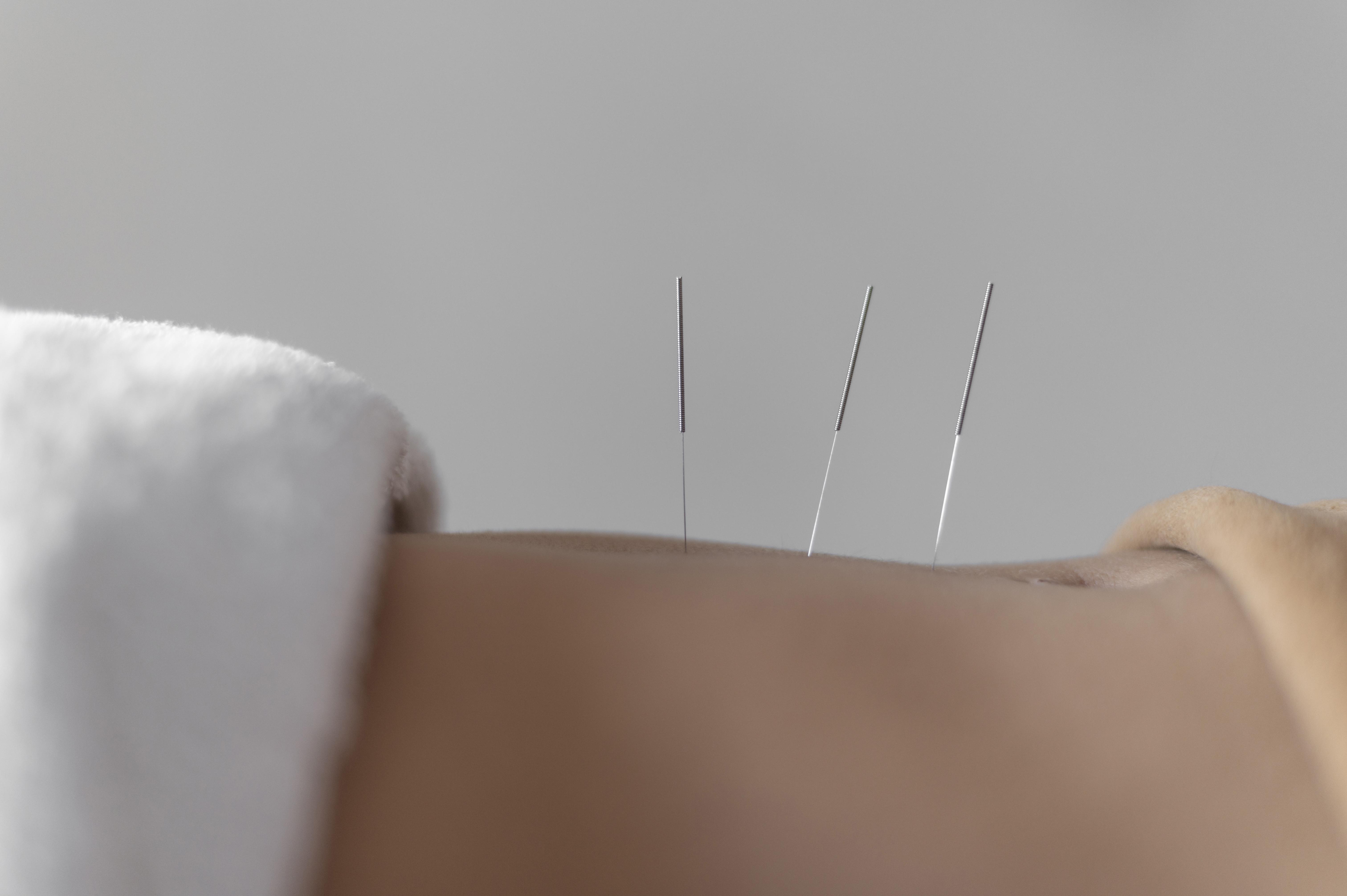 Acupuncture ( à venir)